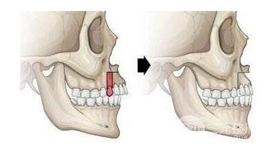 外科正牙手术