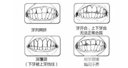成人暴牙