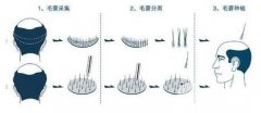 毛发移植果怎么样|毛发移植果优缺点大盘点~