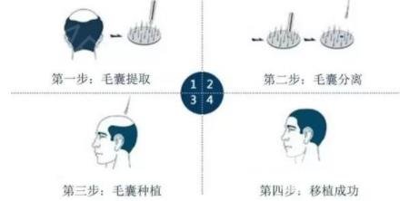 武汉植发手术