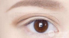 西安割双眼皮修复大约多少钱，有哪些决定价格的因素?