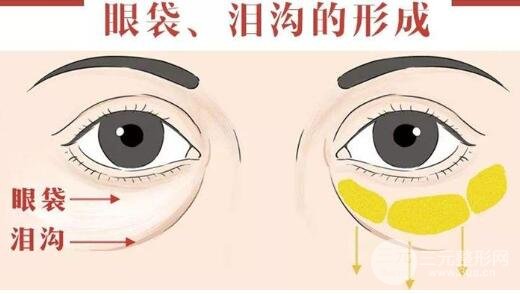 去眼袋