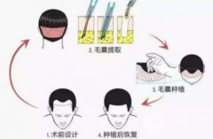 植发失败了吗?3个月新头发都快掉光了 植发失败了吗?3个月新头发都快掉光了
