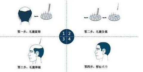 植发失败了