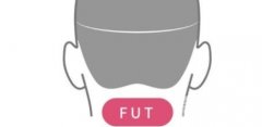 FUE和FUT相比哪个更好,对头皮伤害更小? FUE和FUT相比哪个更好,对头皮伤害更小?