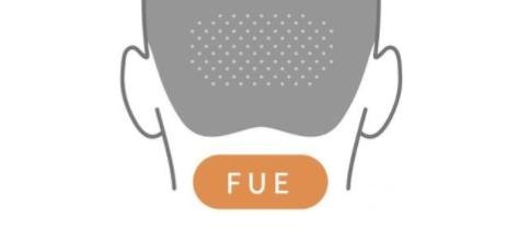 fue植发