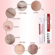 烧伤疤痕康复及疤痕修复应注意哪些问题？