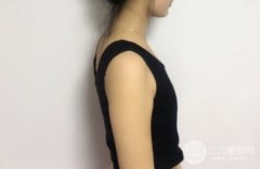 假体隆胸怎么样?术后恢复对比照分享