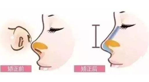 朝天鼻矫正