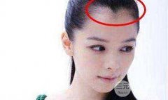 美人尖种植好看吗,发际线高可以种植美人尖吗? 美人尖种植好看吗,发际线高可以种植美人尖吗?
