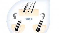 植发提取1000单位毛囊是多少,医生如何确定提取单位? 植发提取1000单位毛囊是多少,医生如何确定提取单位?
