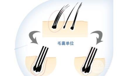 植发1000单位