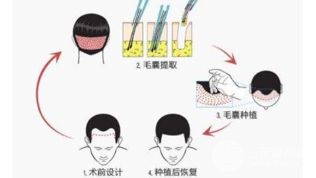 植发1000单位