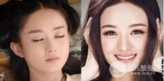 发际线后退还能恢复吗，移植后还能长出来么?