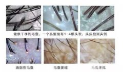 植发前的毛囊检测是必须的吗,毛囊检测能看到什么? 植发前的毛囊检测是必须的吗,毛囊检测能看到什么?