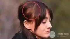 女生21岁脱发,还没到30就开始脱发会秃顶吗? 女生21岁脱发,还没到30就开始脱发会秃顶吗?