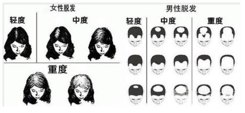 女生21岁脱发