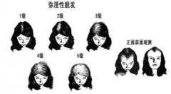 女生头发少怎么办,头发少能做植发手术吗? 女生头发少怎么办,头发少能做植发手术吗?
