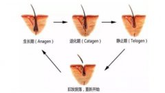 女性脱发三年毛囊会坏死吗,毛囊坏死能植发吗? 女性脱发三年毛囊会坏死吗,毛囊坏死能植发吗?