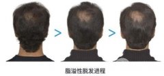 脂溢性脱发能植发吗,脂脱植发会更贵吗? 脂溢性脱发能植发吗,脂脱植发会更贵吗?