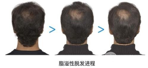 脂脱植发