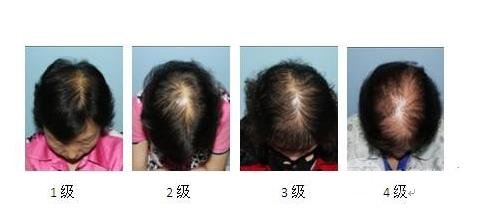 女性植发多钱