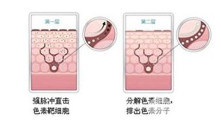 光子嫩肤好吗