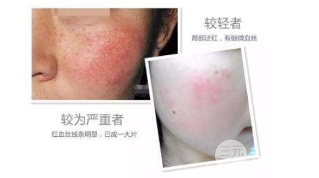 去红血丝多少钱