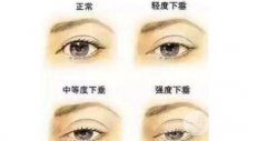 天生眼皮下垂做手术要花多少钱，眼角下垂呢?