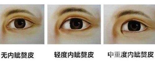 上眼睑下垂