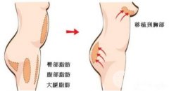 自体脂肪丰胸价格多少钱,是按什么算的? 自体脂肪丰胸价格多少钱,是按什么算的?