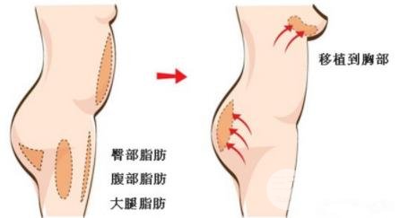 自体脂肪丰胸