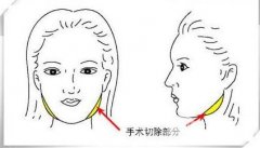下颌角整形多少钱，整牙会改变脸型吗?