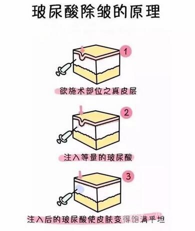 玻尿酸除皱原理