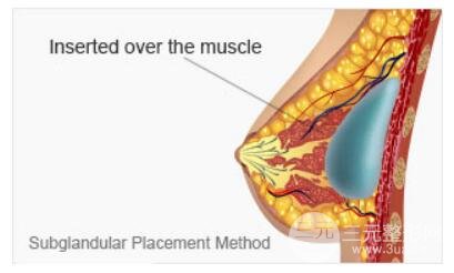 假体隆胸放置位置-腺下