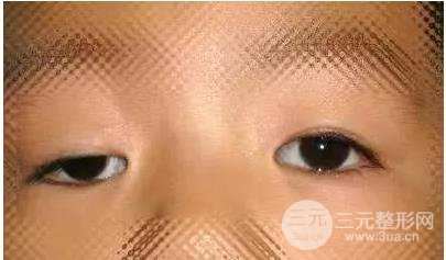 湘雅上睑下垂