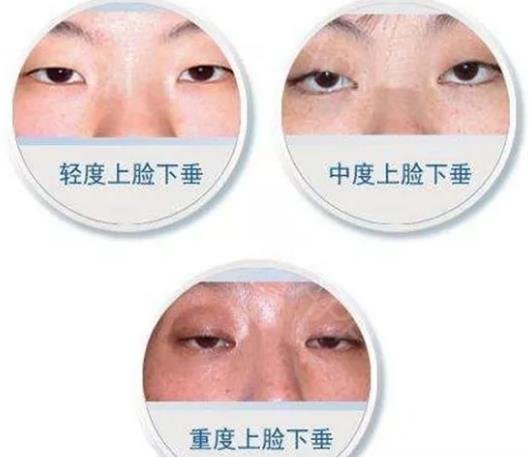 上睑下垂修复