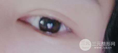 单只眼皮全切