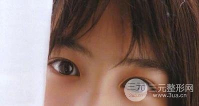 双眼皮