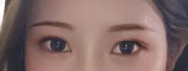 双眼皮手术