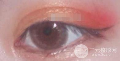 全切双眼皮
