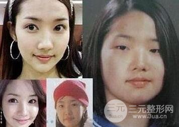 韩国明星整容后遗症
