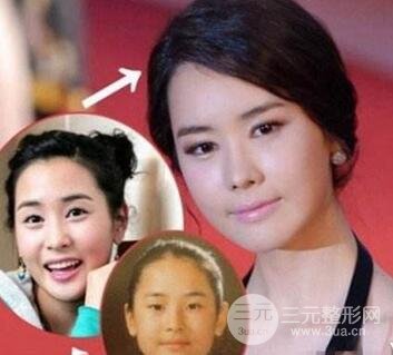 韩国明星整容后遗症