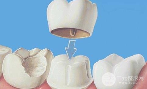烤瓷牙安装