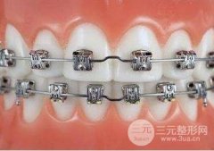 牙齿矫正价格多少钱,三千和一万矫正费用差别在哪? 牙齿矫正价格多少钱,三千和一万矫正费用差别在哪?