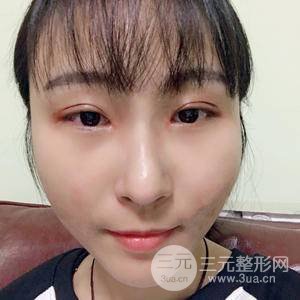 微创全切双眼皮费用详细解说 附33天日记参考