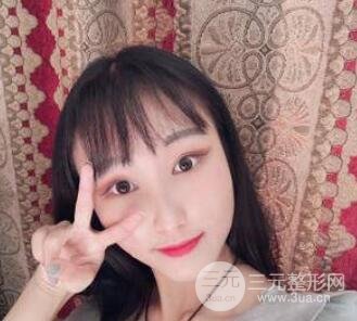微创全切双眼皮费用详细解说 附33天日记参考