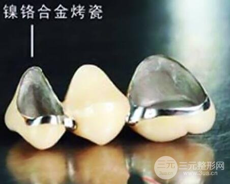 镍铬烤瓷牙,钴铬烤瓷牙