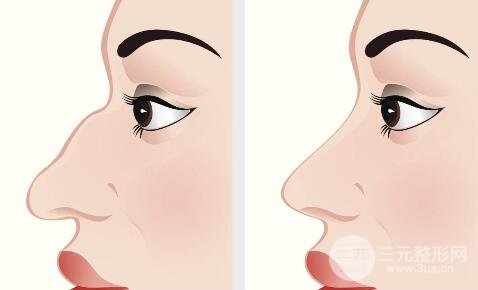 骨膜下隆鼻整形手术怎么做的？哪种情况适合做？