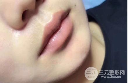 纹唇价格多少